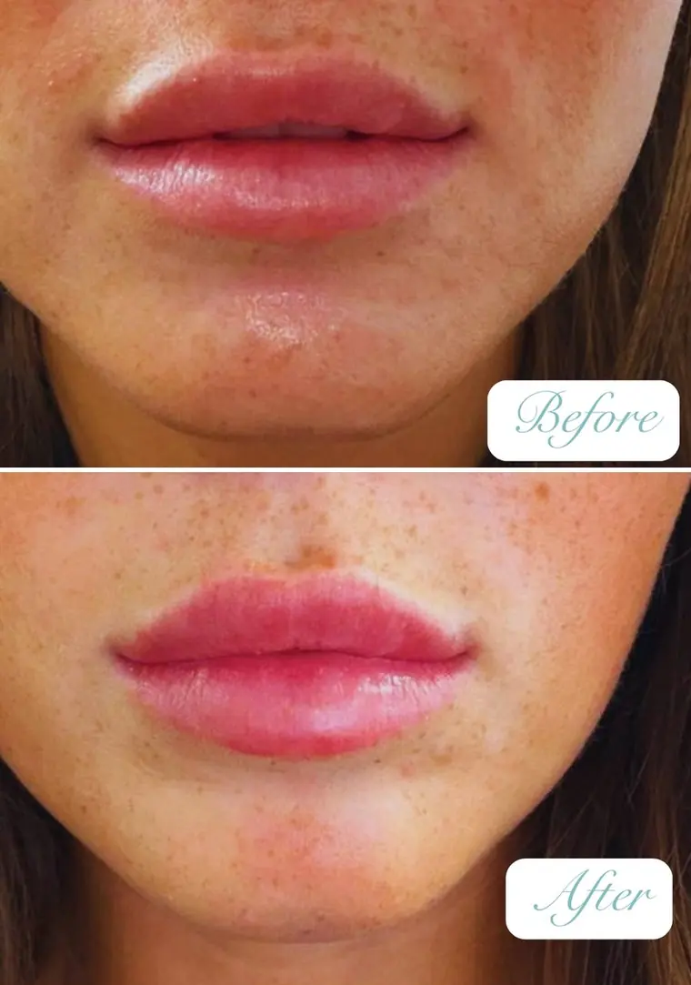 OUR GP patient chin filler before and after