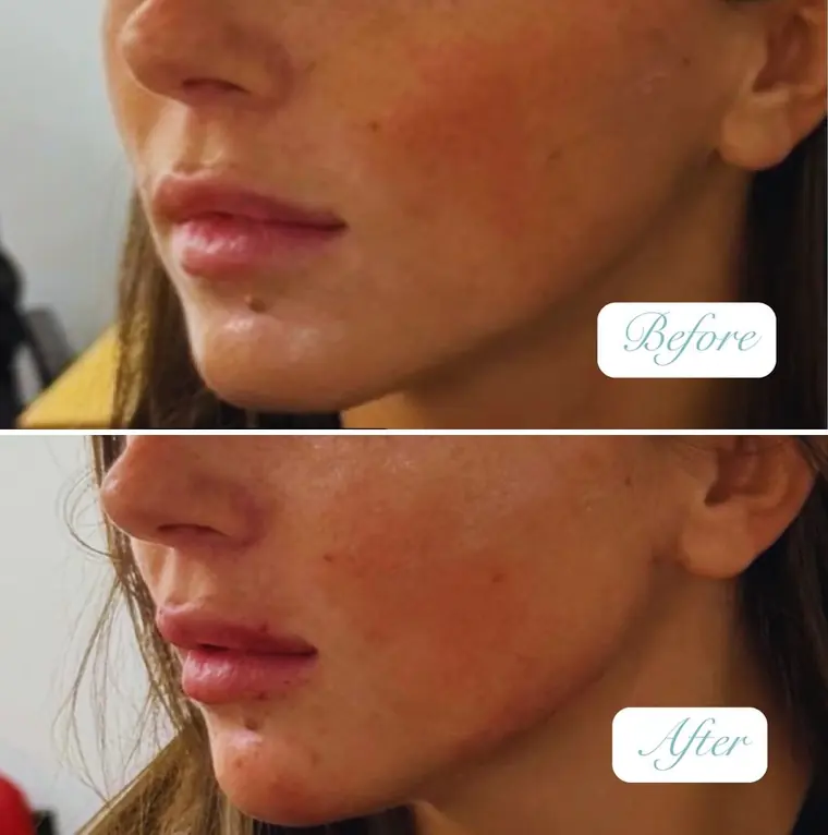 OUR GP patient jawline filler before and after