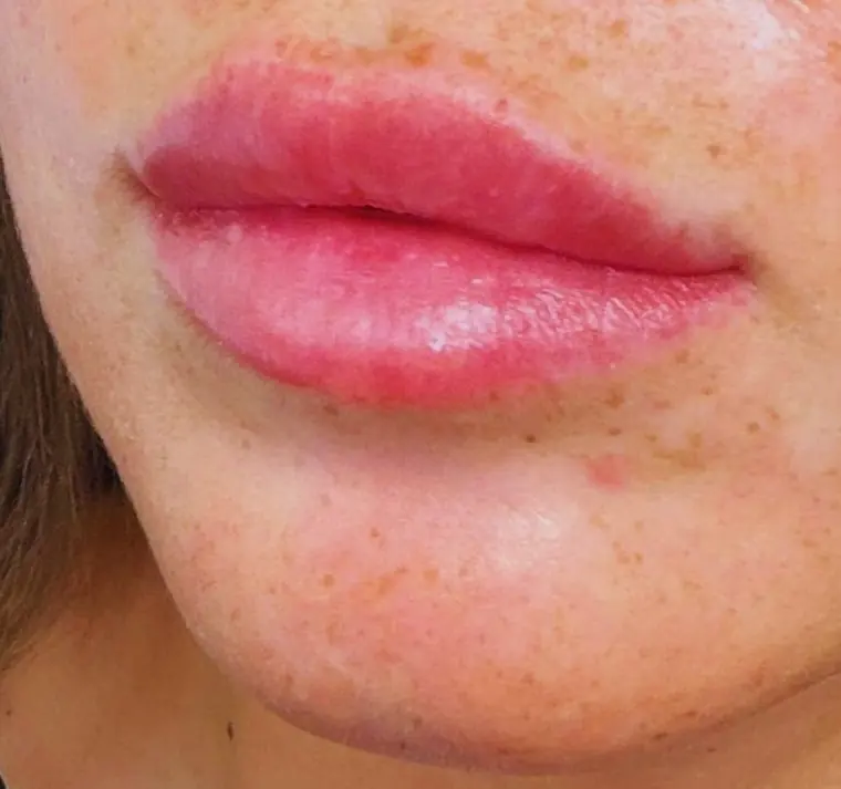 OUR GP patient after lip filler