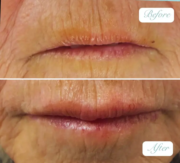 OUR GP patient mature lip filler before and after