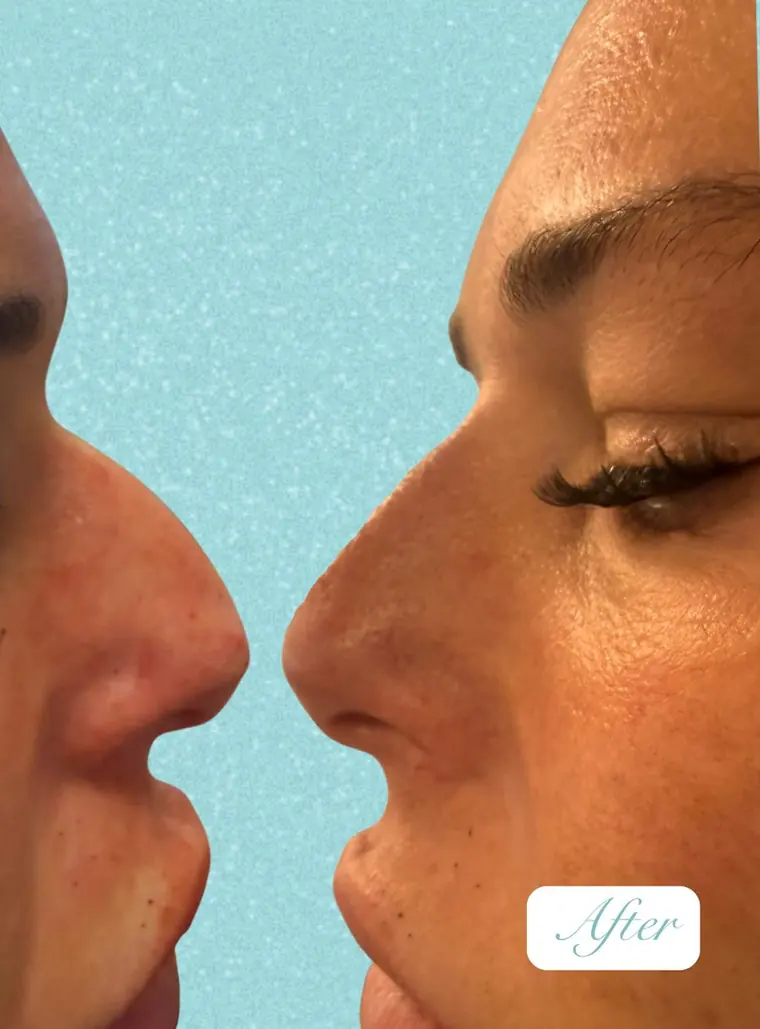 OUR GP patient nose reshaping before and after
