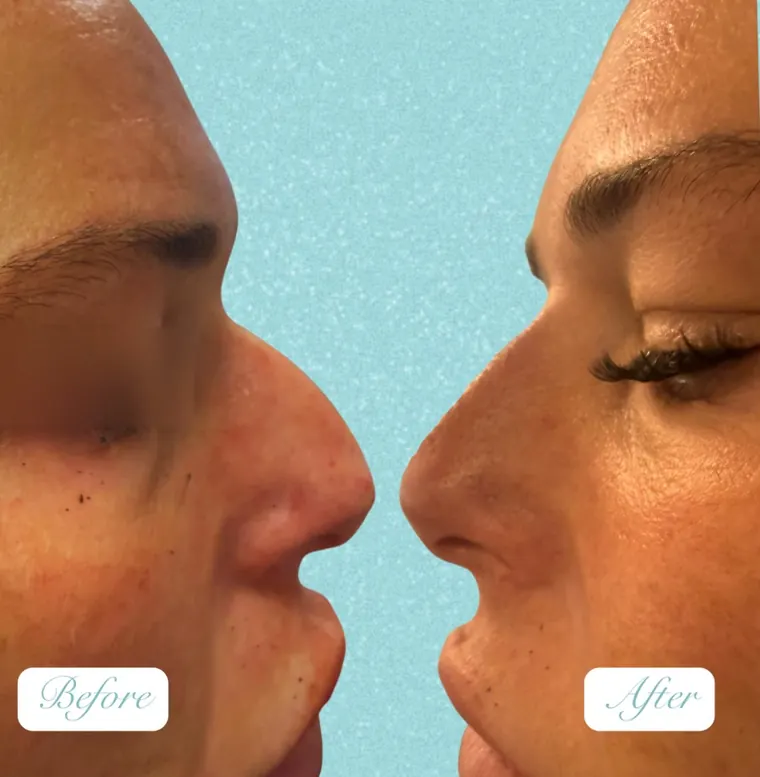 OUR GP patient before and after non-surgical nose reshaping with filler, side profile